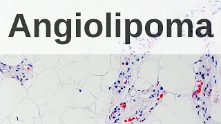 Angiolipoma  Pathology mini tutorial [upl. by Hoxsie]