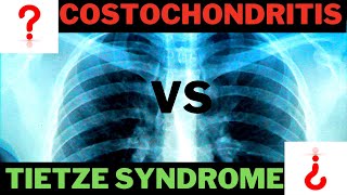 Tietze Syndrome OR Costochondritis [upl. by Durante427]