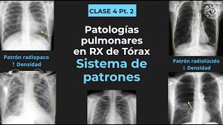 042  Tórax anormal Patrones radiológicos consolidación atelectasia bula cavitación etc [upl. by Idonah]