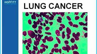 GRACEcast076LungCancerASCO 2011 Highlights  SCLC Early Stage NSCLC and Mesothelioma [upl. by Elletse389]