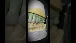 EMax Crown Veneers [upl. by Auberbach45]