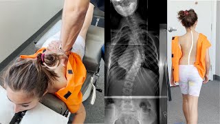 Scoliosis Treatment with Gonstead Chiropractic Care Ep2 Dr Rahim [upl. by Ahsia]