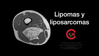 Lipomas y liposarcomas  Dr Andrés Rodríguez U Rosario [upl. by Annadiane100]