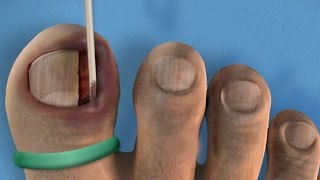 Ingrown Toenail Removal Surgery [upl. by Tema969]