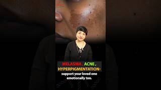 Acne Melasma Hyperpigmentation  How Skin Problems Can Lead to Depression Support amp Understanding [upl. by Ylehsa184]