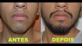 Antes e depois  minoxidil kirkland  barba  7 meses [upl. by Ymerej]