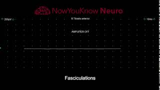 EMG Fasciculations video 2 [upl. by Atnuahsal]