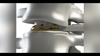 DepuySynthes X PAC Expandable Interbody Cage and UNLEASH TLIF Procedure Animation [upl. by Lasley]