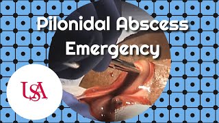 Pilonidal Abscess Emergency Incision amp Drainage [upl. by Sella14]