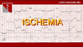 ECG Ischemia [upl. by Assirehs]