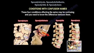 Spondylolysis Spondylolisthesis Spondylitis SpondylosisEverything Need To KnowDr Nabil Ebraheim [upl. by Leiva23]