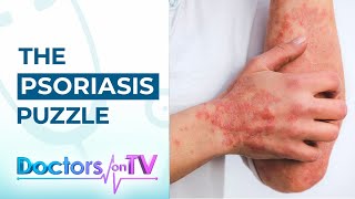 Psoriasis Know the Symptoms Causes and available Treatments from Dermatology Specialist [upl. by Etnad]