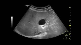 Hepatic cyst liver Rt lobe [upl. by Mojgan]