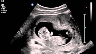 Jumping womb dancer baby ultrasound scan [upl. by Stambaugh]