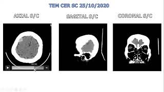 MENINGIOMA CASO CLINICO [upl. by Nawj859]