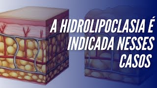 A hidrolipoclasia é indicada nesses casos [upl. by Eberto]