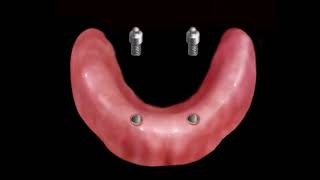 Proteza overdenture na 2 implantach [upl. by Assirahc]