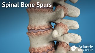 Spinal Bone Spurs [upl. by Ahsiemat196]