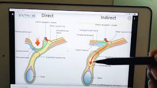 direct vs indirect inguinal hernia [upl. by Hardner]