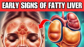 8 Early Signs of FATTY LIVER You Should Never IGNORE [upl. by Marashio]