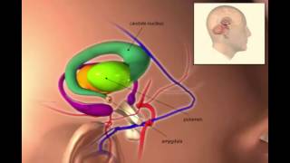 Dystonic Tremor Explained via Digital Storytelling [upl. by Atinrehs]