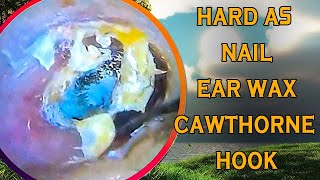 Hard as nails earwax vs cawthorne hook with ear wax removal [upl. by Ramsden620]