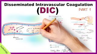 DIC Disseminated Intravascular Coagulation  Part 1 [upl. by Pall106]