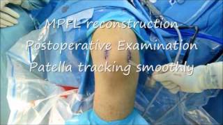 Patella dislocation MPFL reconstruction DrBancha Chernchujitwmv [upl. by Aretse]