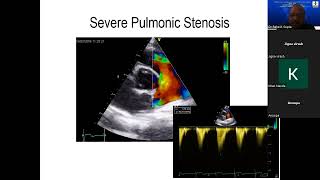 45th Course 202205 15 Pulmonic Stenosis [upl. by Jehovah]