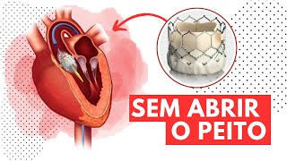 TAVI Cirurgia no Coração Sem Corte Como Funciona [upl. by Hollie704]