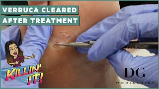 Verruca removal treatment with clearal results  The Foot Scraper DG Podiatrist [upl. by Riatsala]