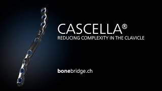 Bonebridge CASCELLA® reducing complexity in the clavicle [upl. by Hildegard]