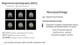 Periventricular Nodular Heterotopia with Samden Lhatoo MD and Nitin Tandon MD [upl. by Murphy]