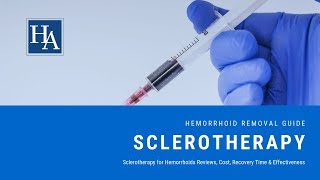 Sclerotherapy for Hemorrhoids Reviews Cost Recovery Time amp Effectiveness [upl. by Hsitirb]