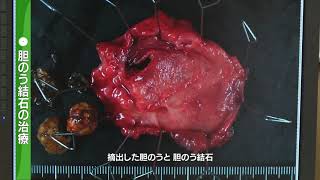 【胆石】正しく理解しよう「胆石症」③胆石症の腹腔鏡手術と内視鏡治療 [upl. by Parthenia226]