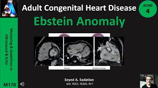 Ebstein Anomaly ACHD 4 [upl. by Elga]