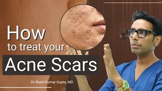 Acne Scars Treatment  Acne Scars Treatment by Dermatologist  Acne Scar Treatment before and after [upl. by Aihtebat]