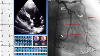 A case of ischemic cardiomyopathy ECG echo SPECT coronary angiography and treatment [upl. by Ohploda851]