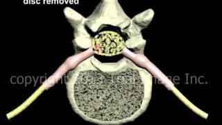 Lumbar Discectomy disc removal and Fusion  Narration and Animation by Cal Shipley MD [upl. by Longley]