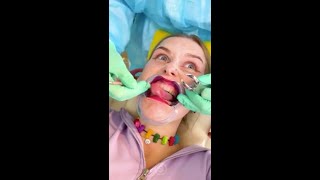 Ho messo delle facciate dentali finte per il dentista 😂 scherzo [upl. by Nnaassilem802]