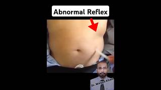 Asymmetrical Abdominal Reflex [upl. by Nathanson88]