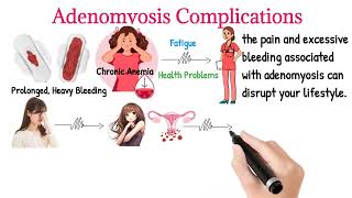 What Are Adenomyosis Complications  Medidoc [upl. by Elleinwad]