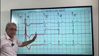 VENTRICULAR ECTOPICS  VENTRICULAR PREMATURE BEATS HOW TO DIAGNOSE ON ECG [upl. by Divd353]