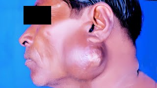 Tuberculous Abscess of Parotid Gland [upl. by Natsirt263]