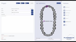 How to set up a single emax crown case in Planmeca PlanCAD® Premium [upl. by Noble]