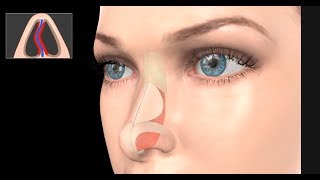 Deviated Septum Surgery Septoplasty [upl. by Samara]