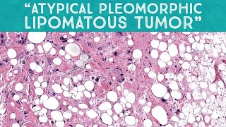 quotAtypical pleomorphic lipomatous tumorquot mimic of liposarcoma AIP France 2021  case 13 [upl. by Salisbarry]