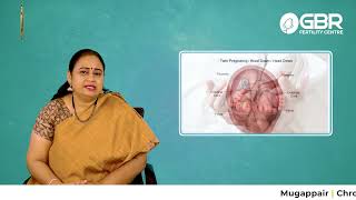 Why twins are common in IVF How Twins are formed Risks in Twin Pregnancy இரட்டை கர்ப்பம்  GBR [upl. by Laen]