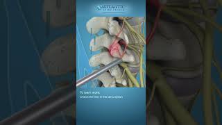 What is Endoscopic Facet Rhizotomy Shorts [upl. by Harden450]