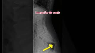 Luxación de Coxis ¿Por qué causa columna dolor coxis caída rayosx short [upl. by Gurtner]